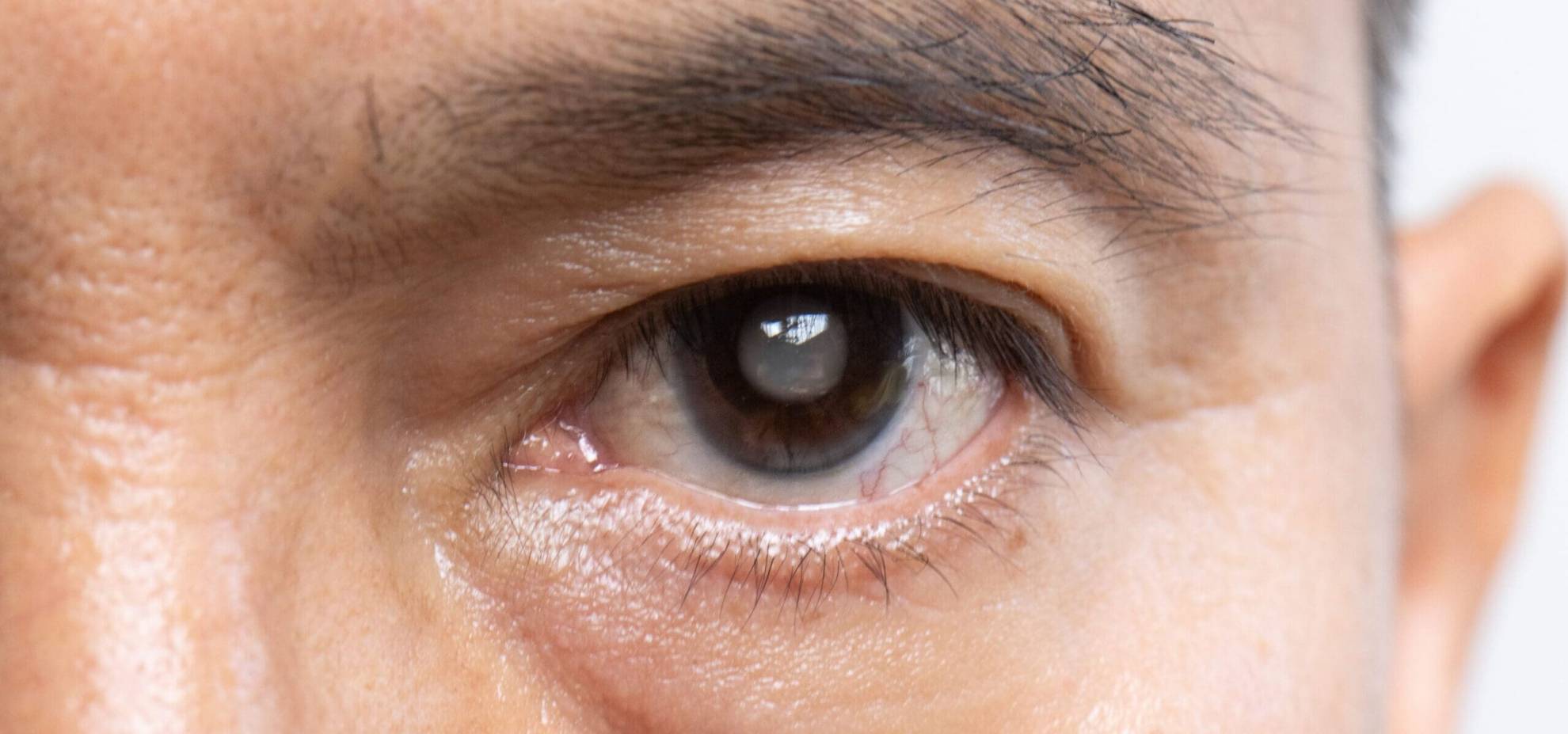 glaucoma treatment in kochi