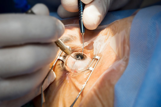 phaco surgery at giridhar eye institute