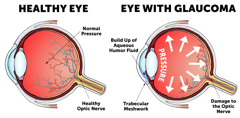 GlaucomaEyeDiagram healthy eye and eye with glaucoma